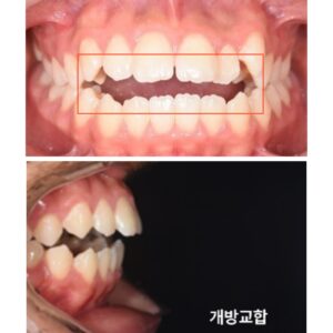 전치부 개방교합과 좁은 위턱이 관찰되는 비발치 교정 치료 전 구강사진