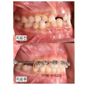 성장기 교정 전후 앞니 반대교합 개선 모습 비교