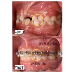 성장기 교정 전후 앞니 반대교합 개선과 영구치 공간 확보 모습
