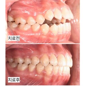 비발치 교정 후 위아래 앞니가 서로 맞물리도록 개선된 치료 종료 구강사진