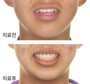 개방교합 교정 완료 후 위아래 치열 폭과 전체 교합이 안정된 모습