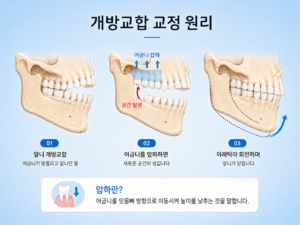 교정용 미니스크류와 고무줄을 이용해 위쪽 어금니를 잇몸 방향으로 이동시키는 원리 설명 이미지