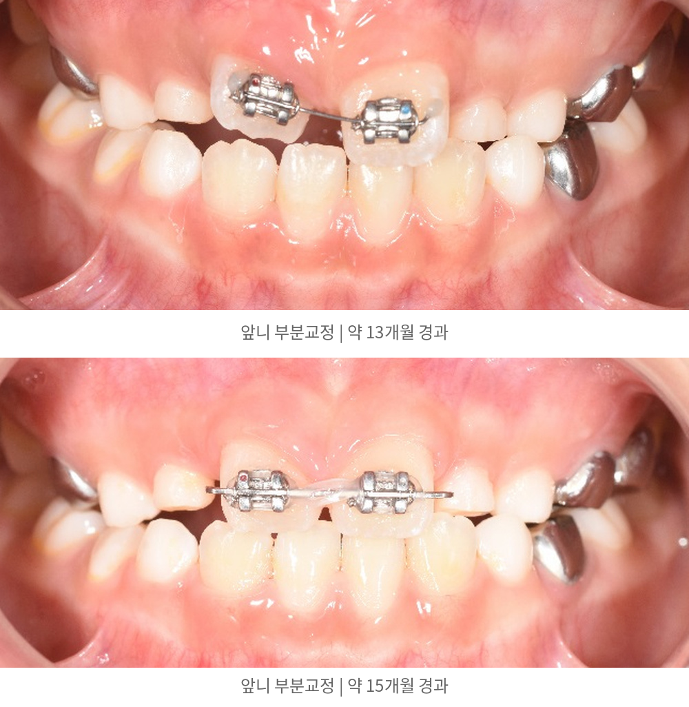 고정식 장치로 새 앞니의 배열을 조절한 과정 | Anterior Orthodontic Treatment Progress | 바른이라인치과 바른이라인치과 영구치 맹출공간 치료사례, 고정식 장치로 새 앞니의 배열을 조절한 과정, anterior orthodontic treatment progress