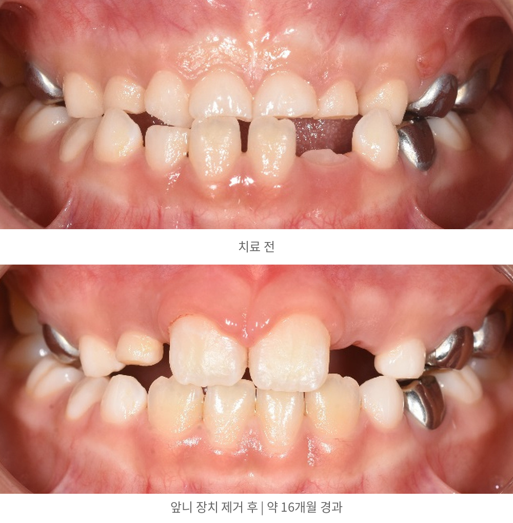 정면 비교 — 위: 치료 전 / 아래: 앞니 장치 제거 후 | Crossbite Before and After | 바른이라인치과 바른이라인치과 영구치 맹출공간 치료사례, 정면 비교 — 위: 치료 전 / 아래: 앞니 장치 제거 후, crossbite before and after