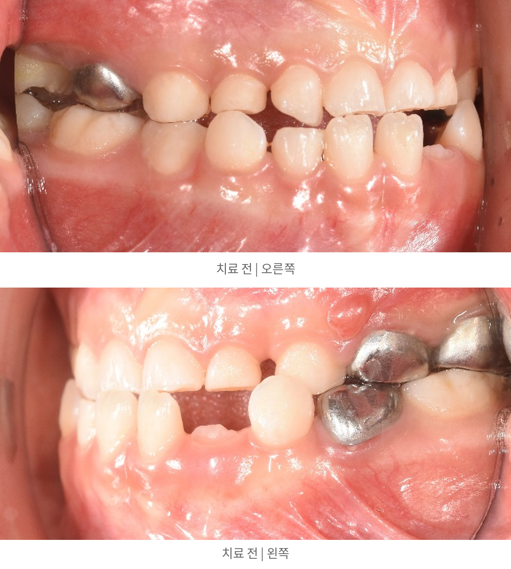 치료 전 측면 사진 — 위: 오른쪽 / 아래: 왼쪽 | Lateral Oral Photos Before | 바른이라인치과 바른이라인치과 영구치 맹출공간 치료사례, 치료 전 측면 사진 — 위: 오른쪽 / 아래: 왼쪽, lateral oral photos before
