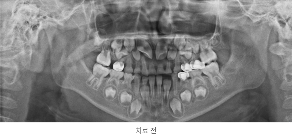 유치와 잇몸 속 영구치의 위치를 살핀 치료 전 파노라마 | Panoramic X-ray Before | 바른이라인치과 바른이라인치과 영구치 맹출공간 치료사례, 유치와 잇몸 속 영구치의 위치를 살핀 치료 전 파노라마, panoramic x-ray before