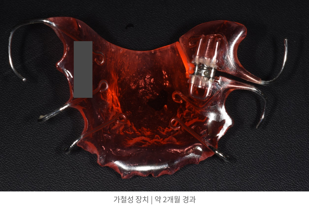 이번 치료에 사용한 가철성 장치 | Removable Orthodontic Appliance | 바른이라인치과 바른이라인치과 영구치 맹출공간 치료사례, 이번 치료에 사용한 가철성 장치, removable orthodontic appliance