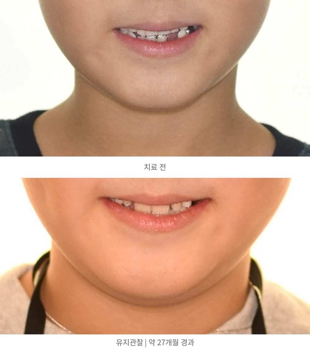 치료 전과 유지관찰 당시의 입 주변 기록 | Smile Before and Follow-up | 바른이라인치과 바른이라인치과 영구치 맹출공간 치료사례, 치료 전과 유지관찰 당시의 입 주변 기록, smile before and follow-up