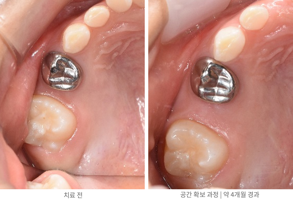 오른쪽 위 어금니 부위 — 왼쪽: 치료 전 / 오른쪽: 치료 중 | Space Regaining Progress | 바른이라인치과 바른이라인치과 영구치 맹출공간 치료사례, 오른쪽 위 어금니 부위 — 왼쪽: 치료 전 / 오른쪽: 치료 중, space regaining progress