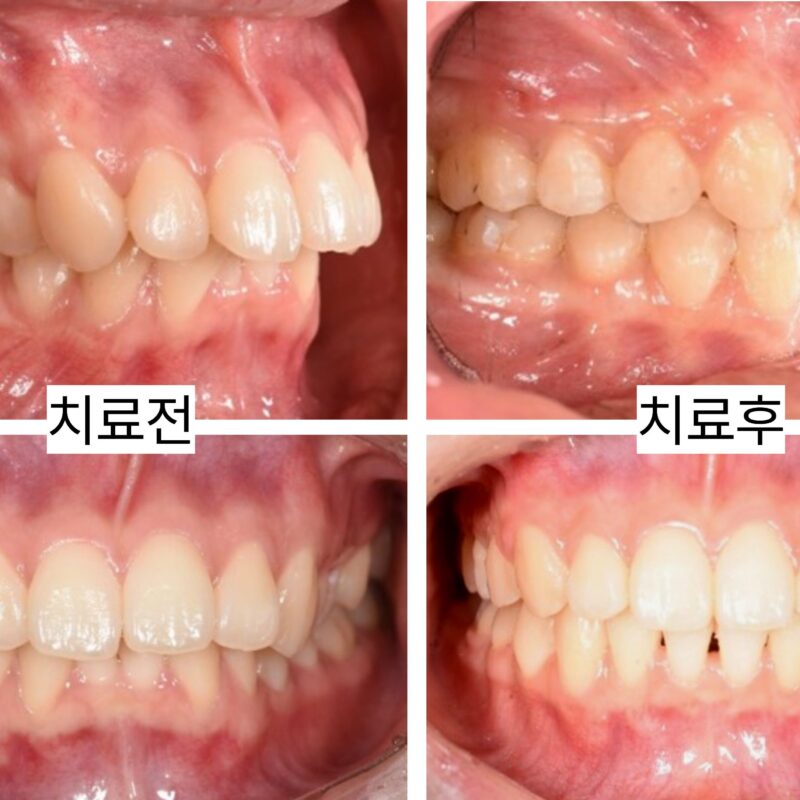 앞니 겹침과 돌출입까지 개선한 비발치 교정 사례