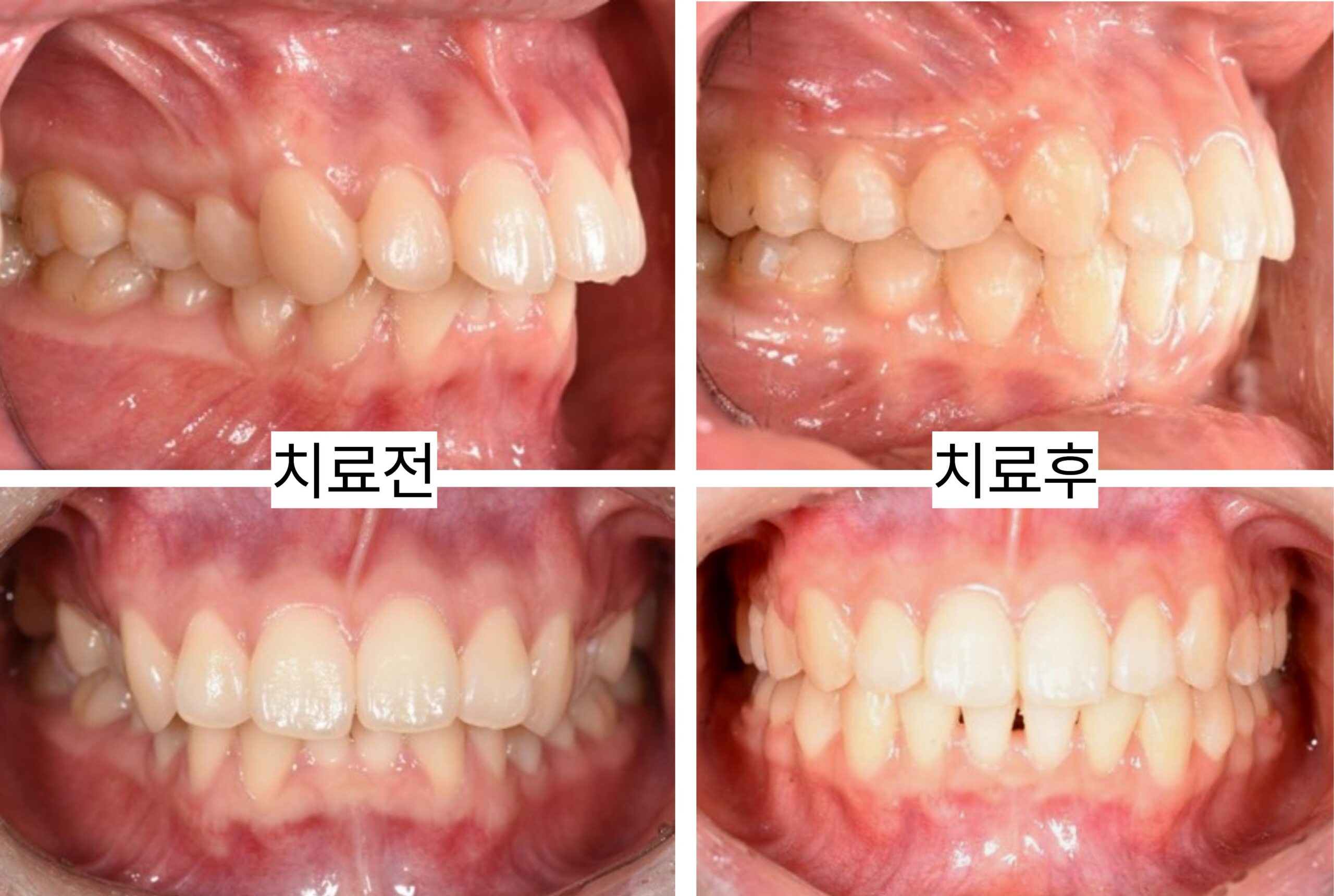 앞니 겹침과 돌출입까지 개선한 비발치 교정 사례