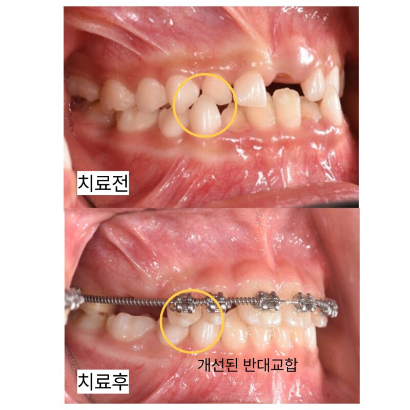 성장기 교정으로 앞니 반대교합을 개선한 사례