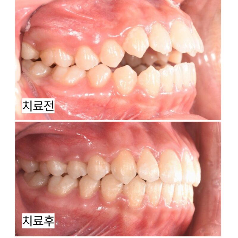 앞니가 닿지 않는 개방교합, 발치 없이 개선한 사례-동백치과