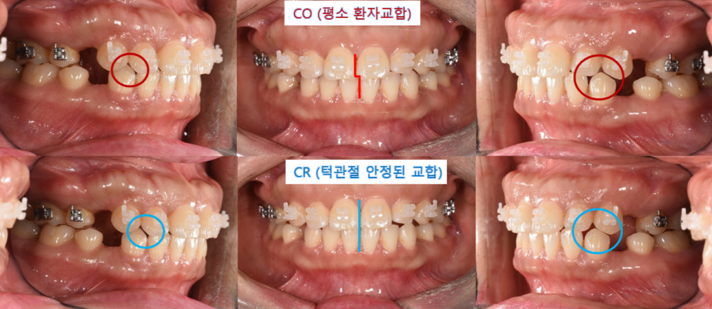 돌출입 교정 전 평소 교합과 턱관절 안정위 교합 비교