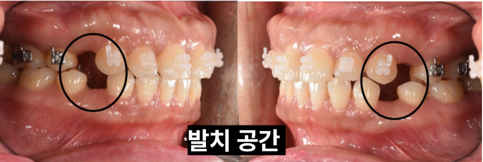 돌출입 발치교정 중 작은어금니 발치 공간