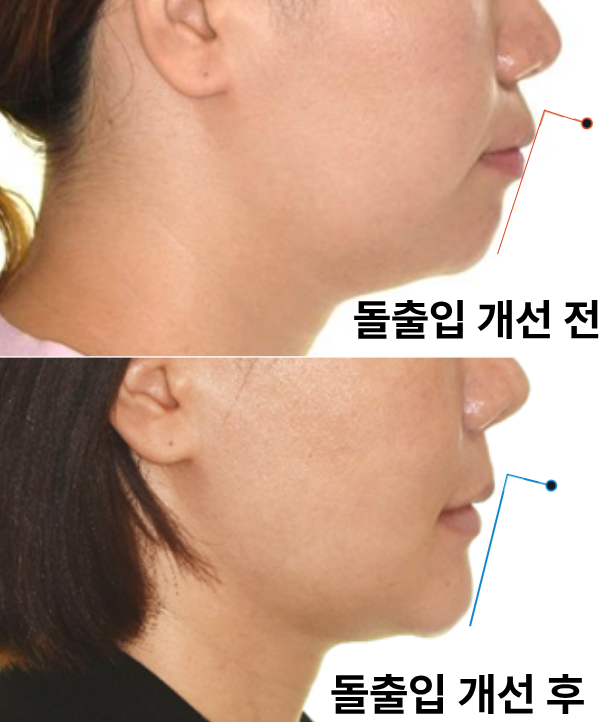 돌출입 발치교정 전후 측면과 입술 돌출감 비교