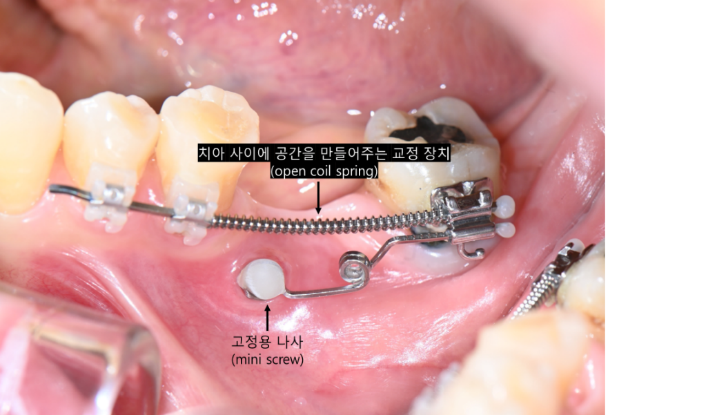 부분교정 중 임플란트 공간 확보를 위한 스프링과 미니스크류