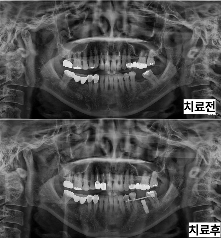 부분교정과 임플란트 치료 전후 파노라마 비교