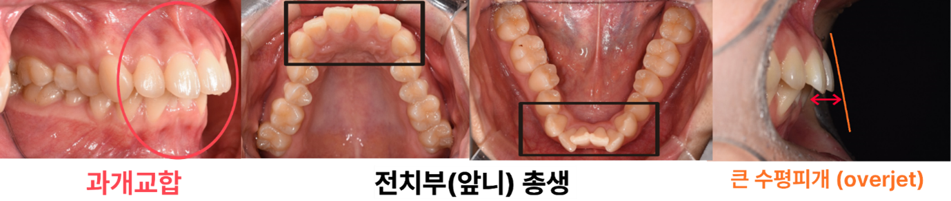 치료 시작 당시: 과개교합·앞니 겹침·수평피개와 치열궁의 폭을 확인한 기록