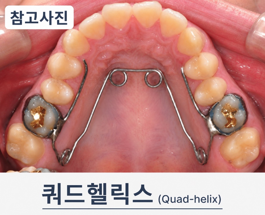 쿼드헬릭스의 형태를 설명하는 AI 참고 이미지. 실제 환자 사진이 아닙니다.