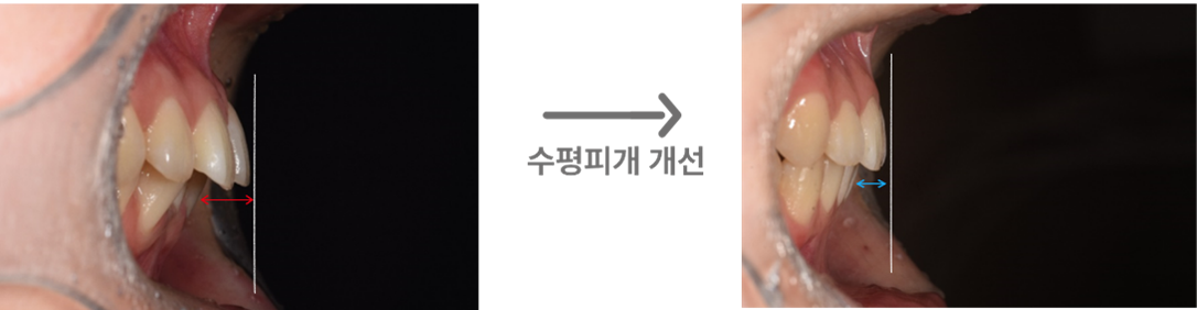 측면 비교: 왼쪽이 치료 시작 당시, 오른쪽이 치료 종료 당시입니다.
