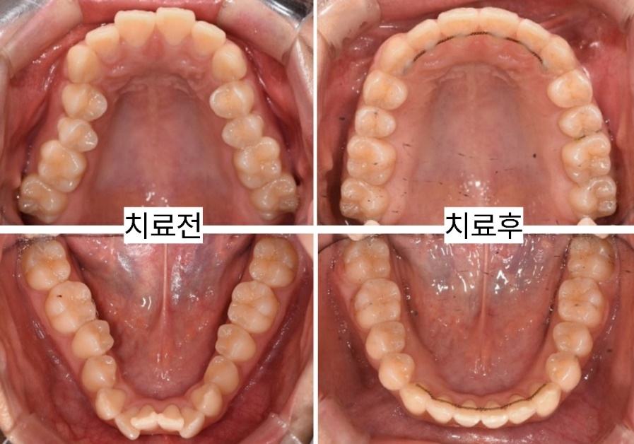 치열궁과 앞니 배열 비교: 왼쪽이 치료 전, 오른쪽이 치료 후입니다.