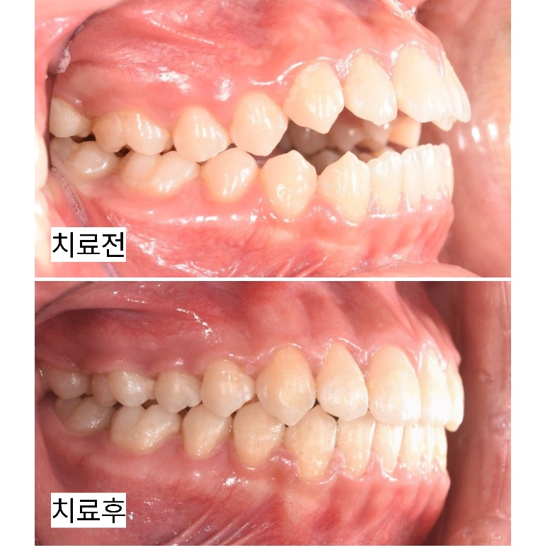 앞니가 닿지 않는 개방교합, 발치 없이 개선한 사례