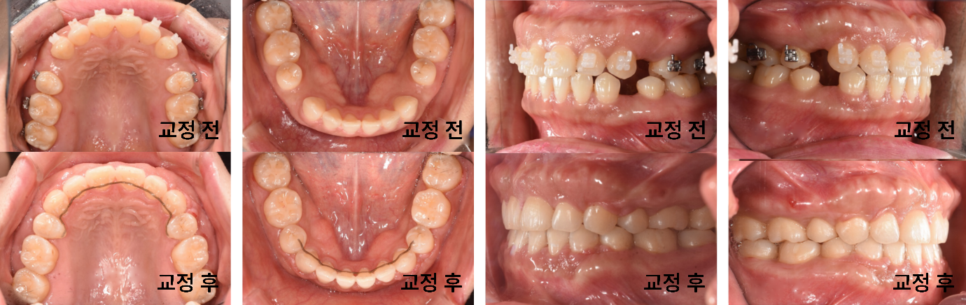 입이 나와 보여요, 돌출입 교정에서 작은어금니를 발치한 이유
