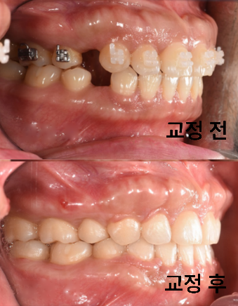 입이 나와 보여요, 돌출입 교정에서 작은어금니를 발치한 이유 · 치료 전