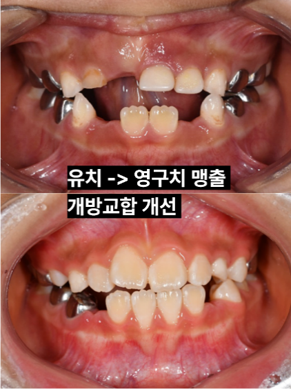 앞니가 서로 닿지 않는 아이 성장기 개방교합 치료 사례 · 치료 전