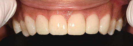 바른이라인치과 위 앞니 라미네이트 치료 후, dental veneers after