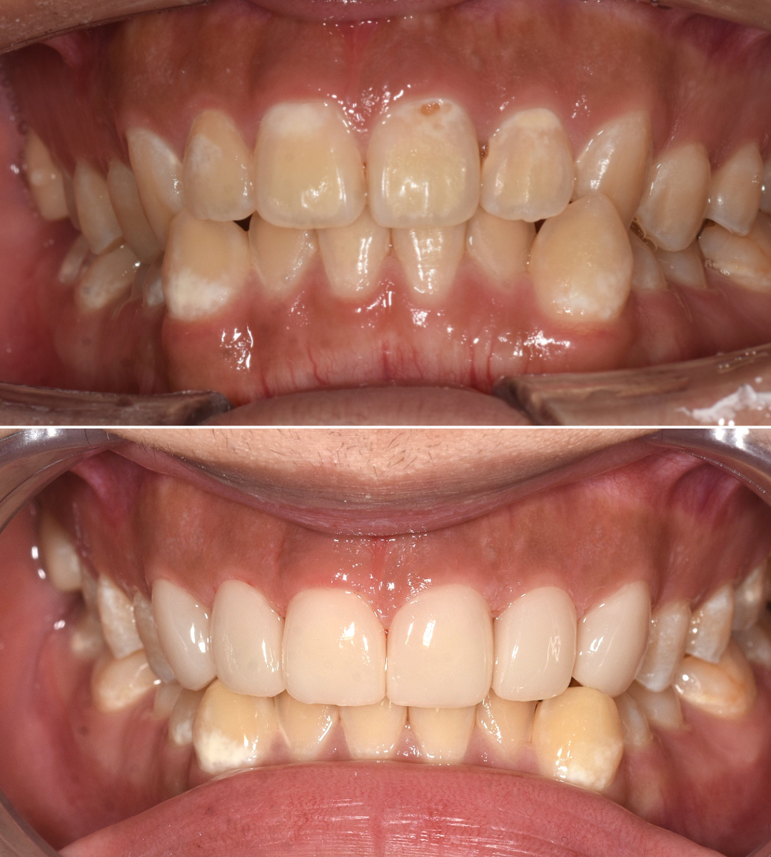 바른이라인치과 앞니 충치 라미네이트 치료 전후, dental caries veneers before and after