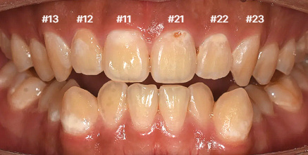 바른이라인치과 앞니 충치 치료 전 정면, dental caries before frontal