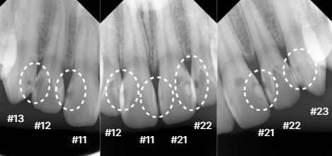 바른이라인치과 앞니 충치 치료 전 방사선사진, dental caries before x-ray