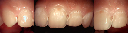 바른이라인치과 앞니 인접면 충치 제거 과정, interproximal caries removal