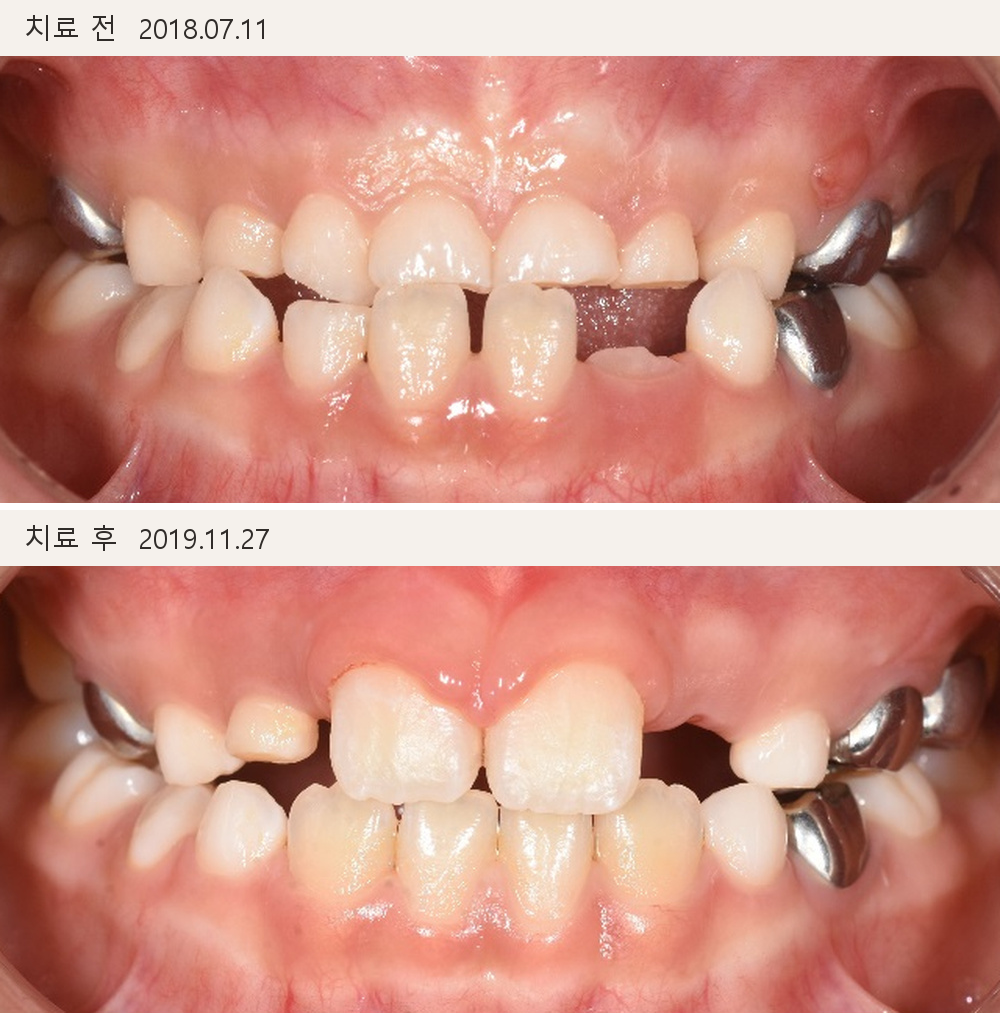 유치가 일찍 빠져 좁아진 자리, 영구치가 나올 수 있을까요?