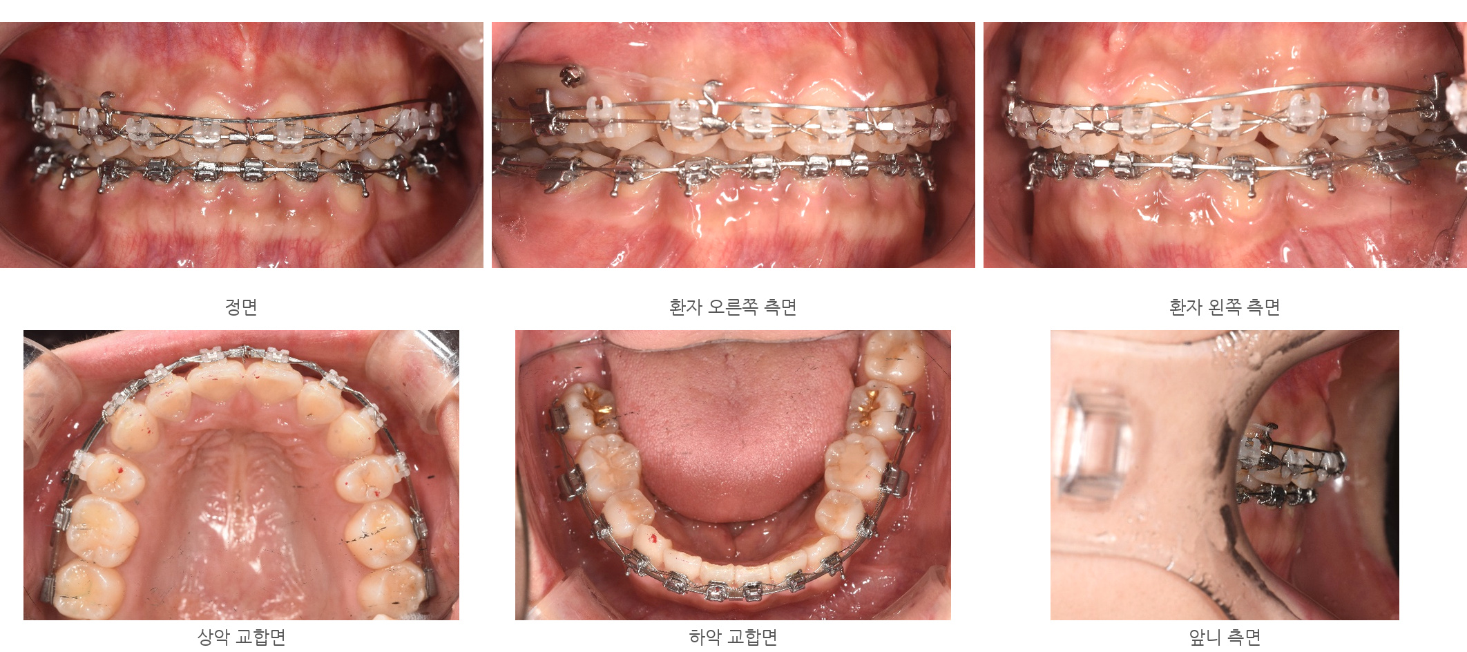 바른이라인치과 옥니 재교정, 정면·양측면·교합면에서 살핀 위아래 치열, alignment progress 20m