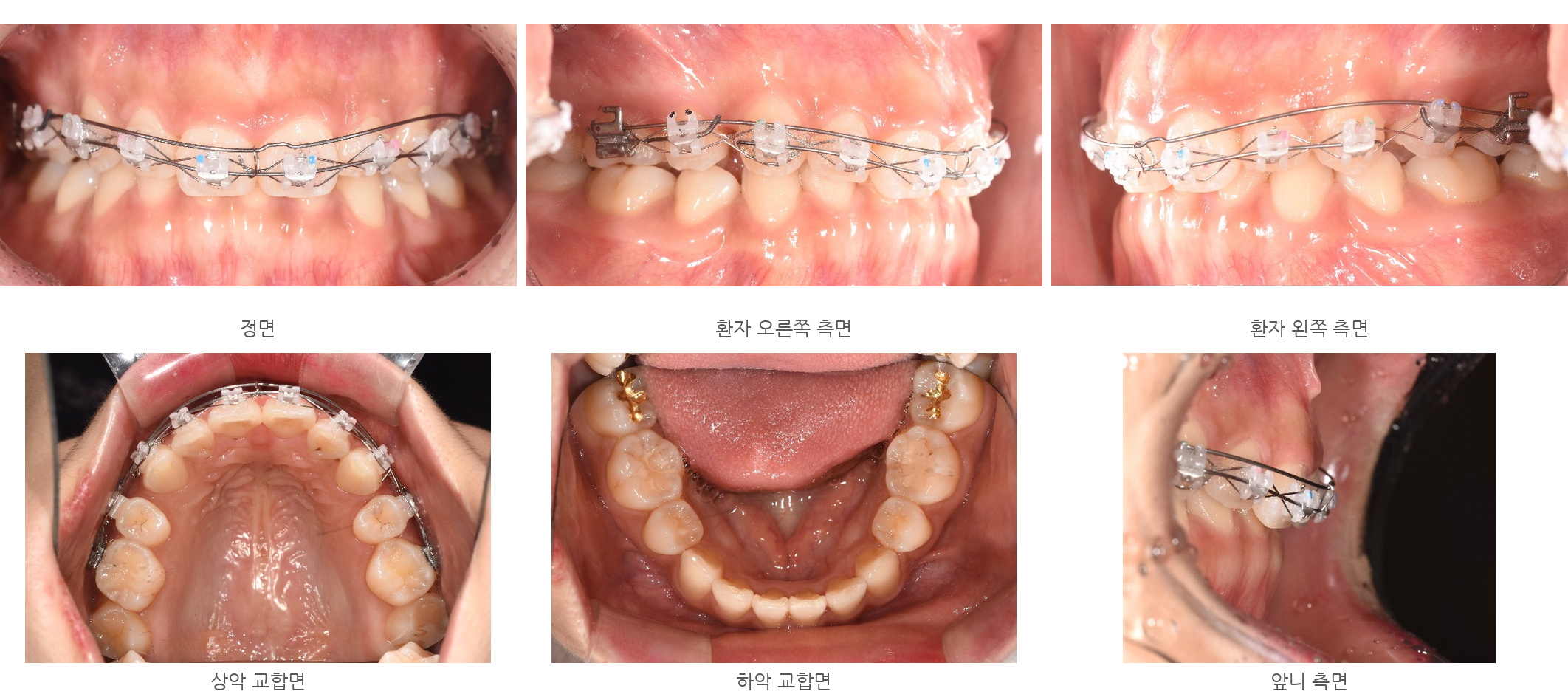 바른이라인치과 옥니 재교정, 윗앞니 구간에 와이어와 보조 와이어를 연결한 모습, appliance start