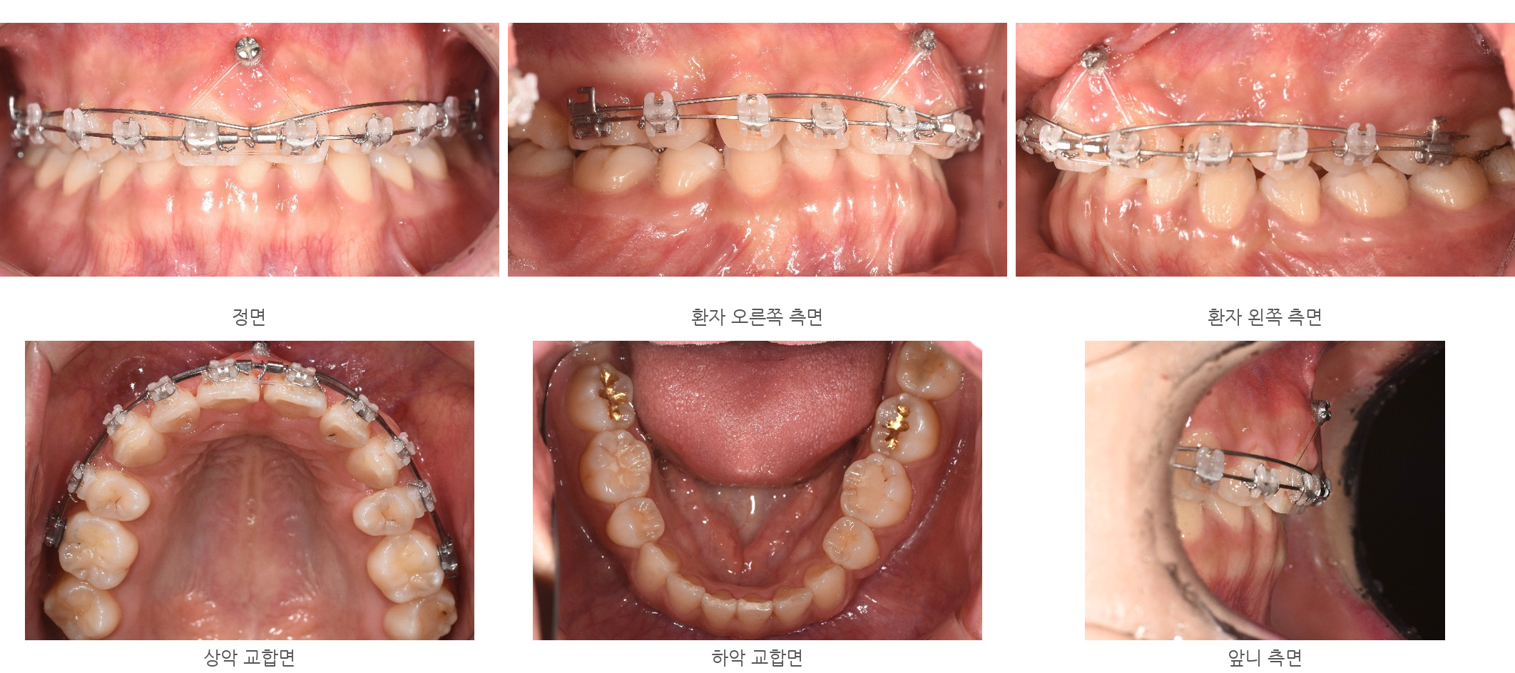 바른이라인치과 옥니 재교정, 위아래 치아가 닿는 상태와 앞니의 방향을 살핀 모습, bite progress 09m