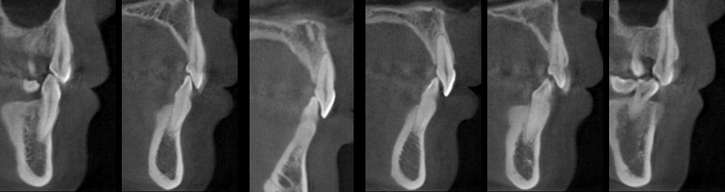 바른이라인치과 옥니 재교정, 앞니의 뿌리 방향과 주변 잇몸뼈를 살핀 자료, incisor ct before