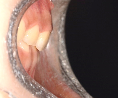 바른이라인치과 옥니 재교정, 안쪽으로 기울어진 윗앞니의 방향을 살핀 모습, incisor lateral before