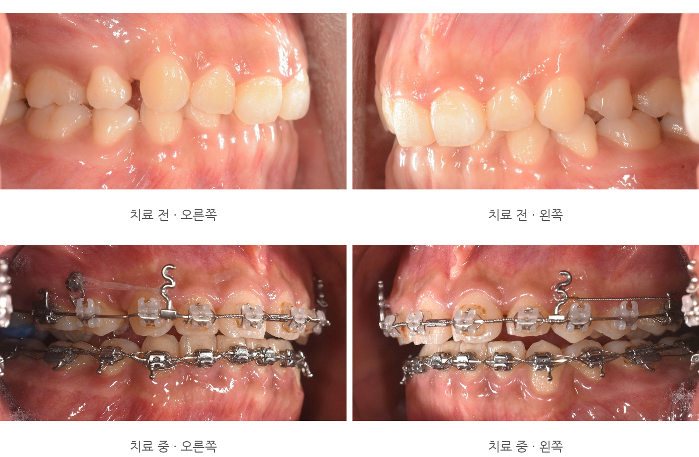 바른이라인치과 옥니 재교정, 오른쪽과 왼쪽의 앞니·어금니 교합을 비교한 모습, lateral before progress