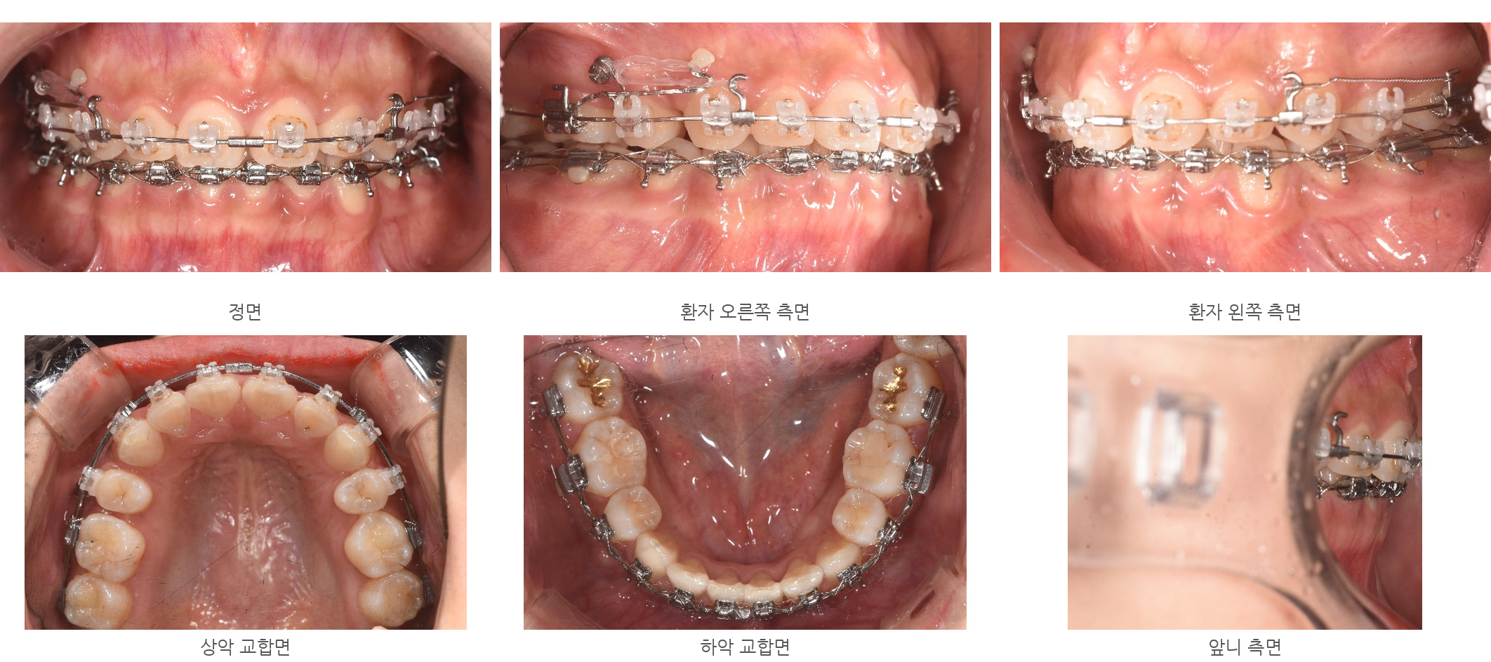 바른이라인치과 옥니 재교정, 앞니와 어금니의 교합 조절을 이어간 모습, occlusion progress 23m