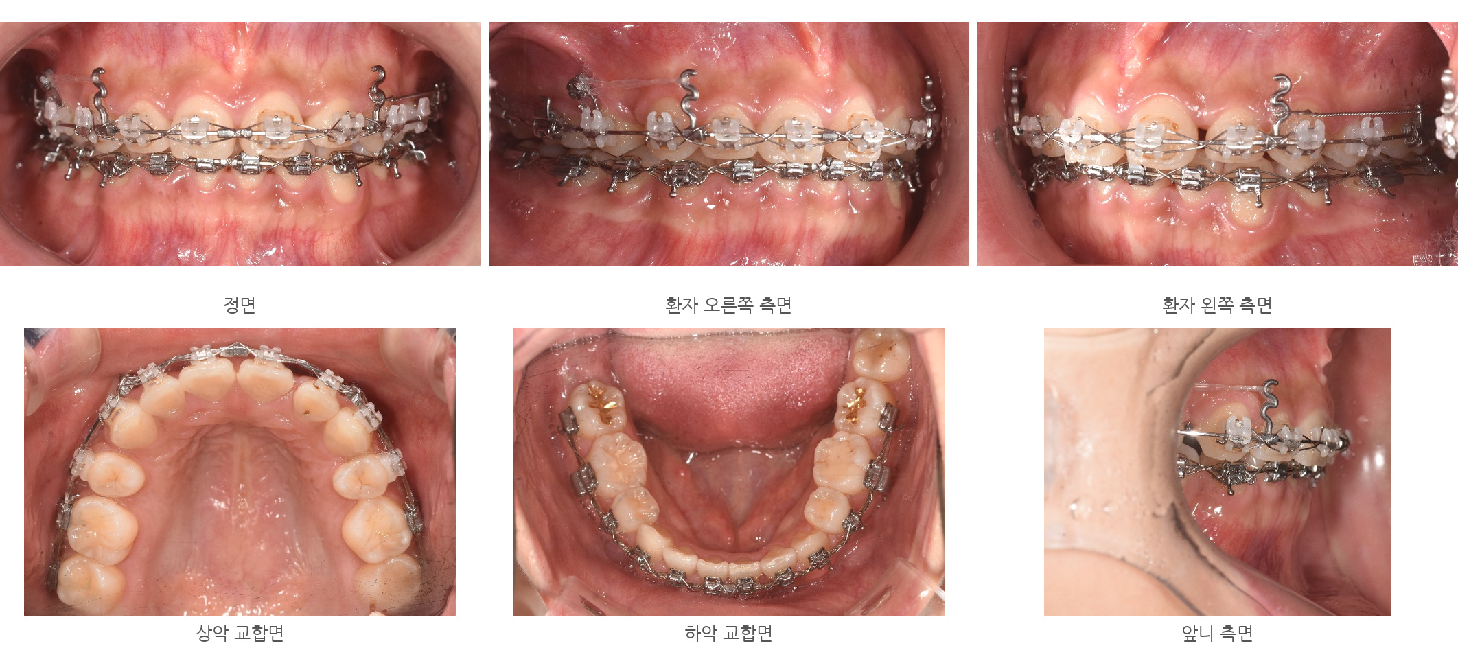 바른이라인치과 옥니 재교정, 정면·양측면·교합면에서 살핀 치료 중 경과, occlusion progress 25m