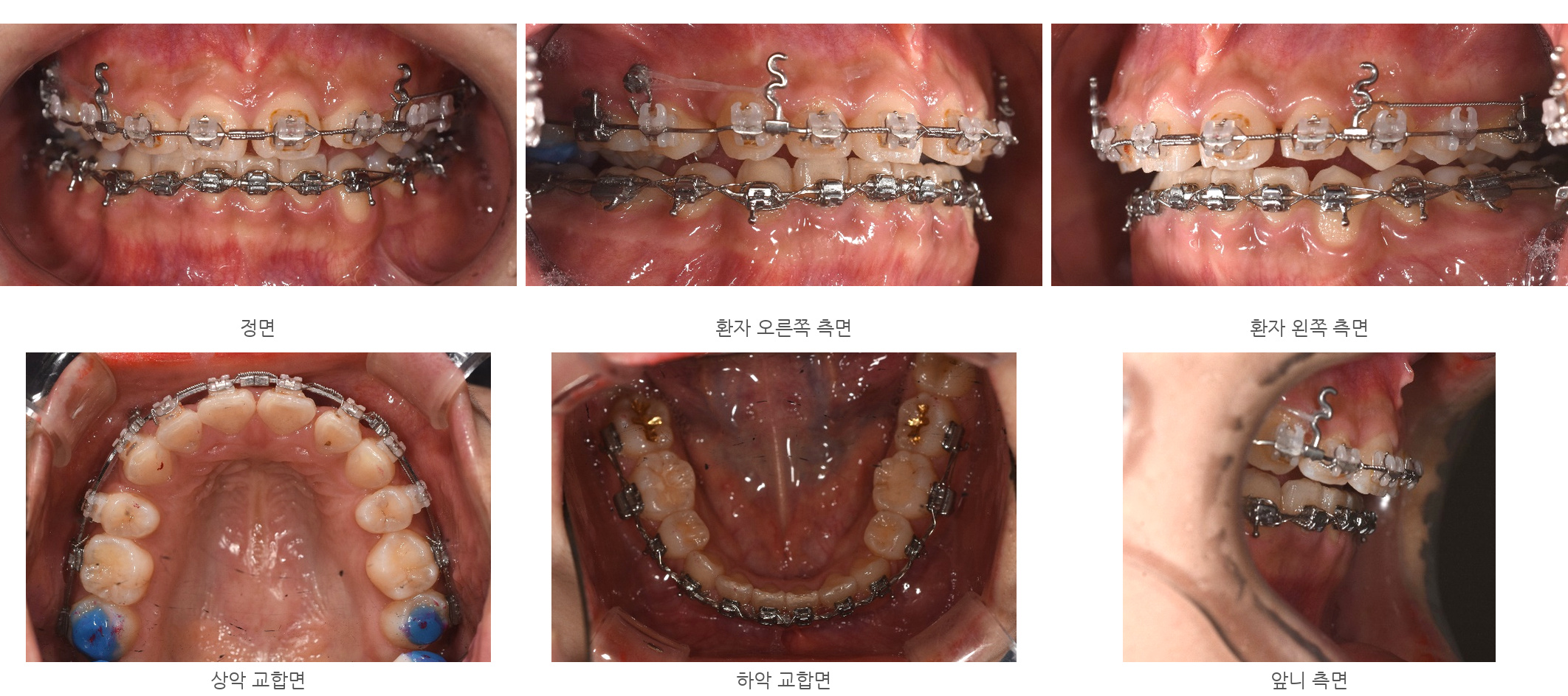 바른이라인치과 옥니 재교정, 위아래 교정장치를 유지하며 치료를 이어가는 모습, occlusion progress 26m