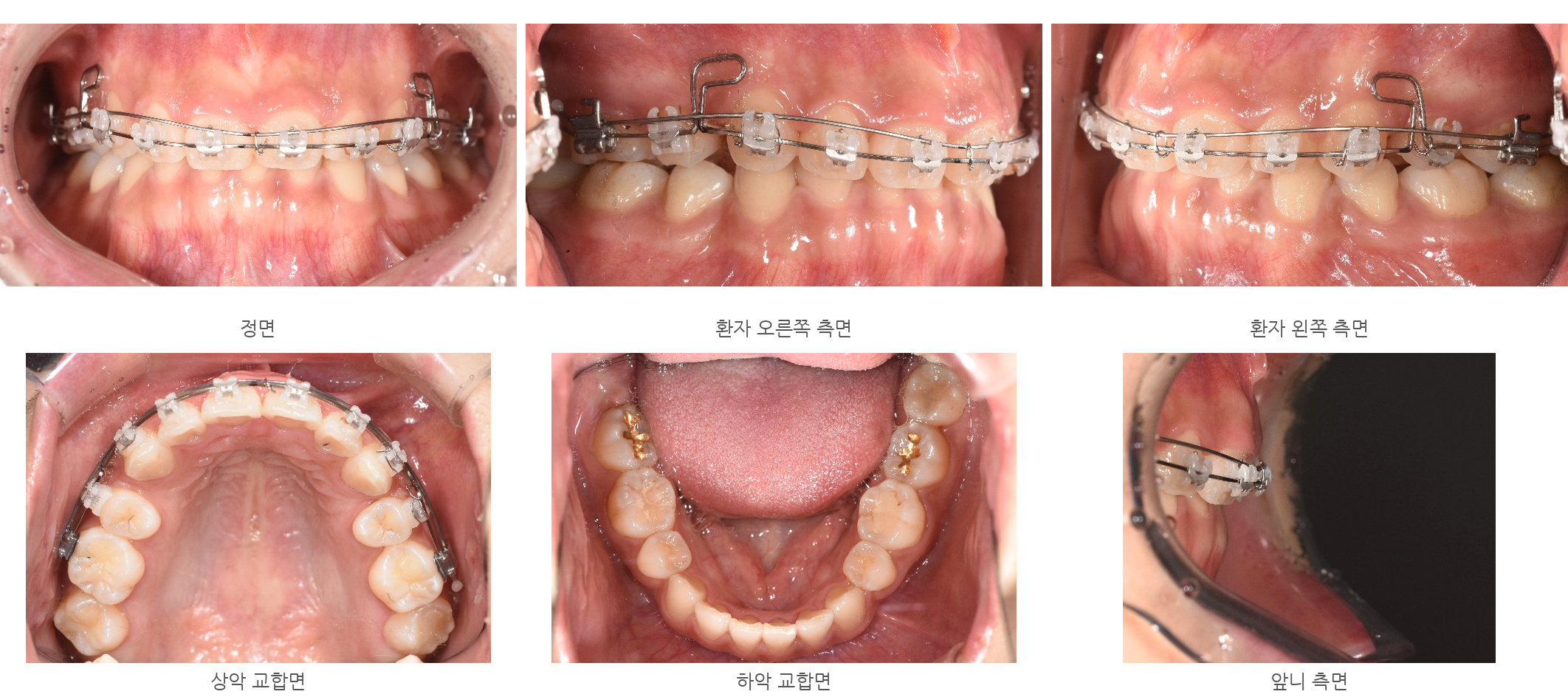 바른이라인치과 옥니 재교정, 고리 형태의 와이어와 압하용 보조 와이어를 적용한 모습, torque progress 02m