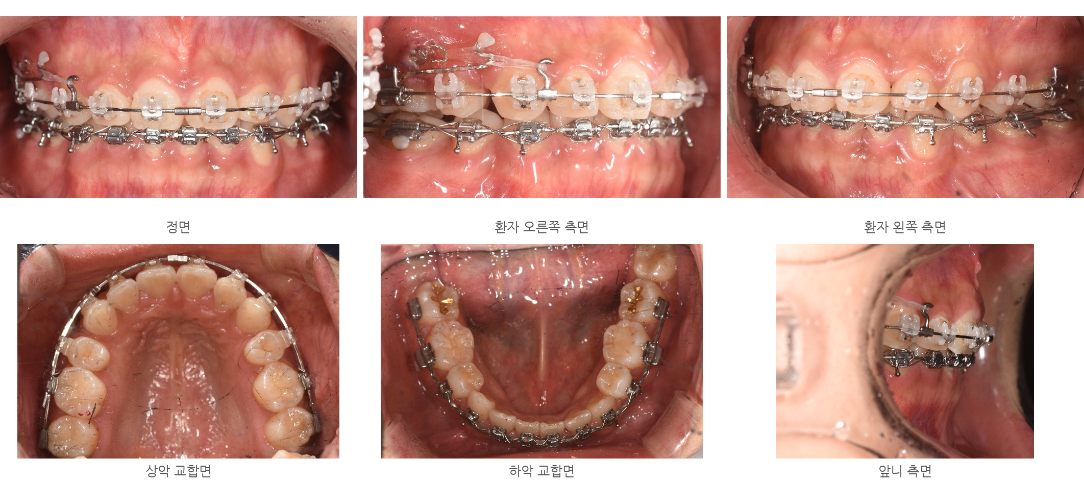 바른이라인치과 옥니 재교정, 앞니의 기울기와 치아가 닿는 상태를 살핀 모습, wire progress 21m
